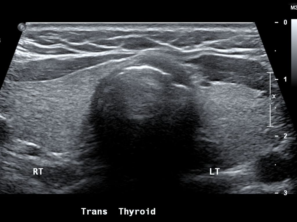 normal-thyroid-echotexture-nucsradiology