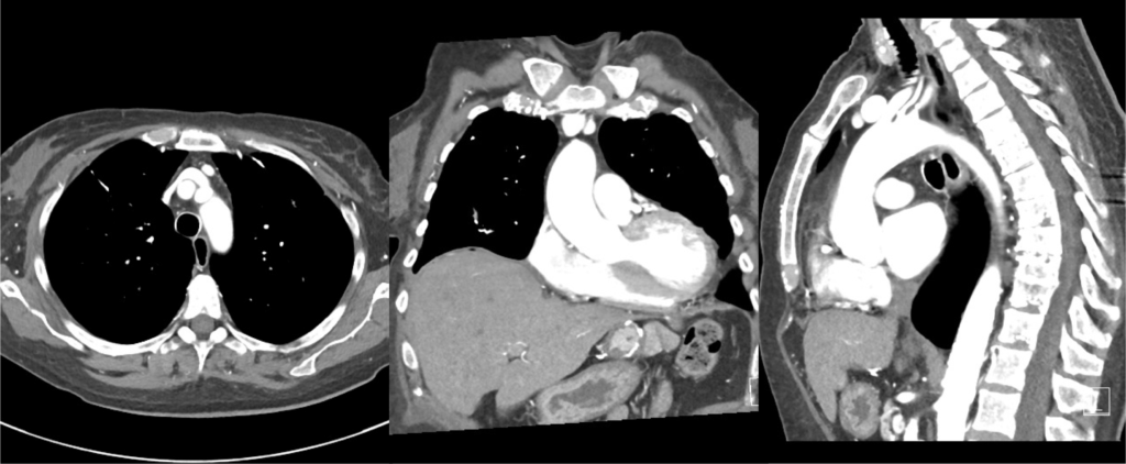 Axial Coronal And Sagittal CT Images NucsRadiology