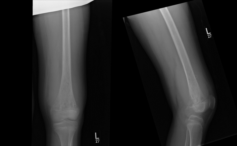 AP and lateral radiographs of the left femur | NucsRadiology.com