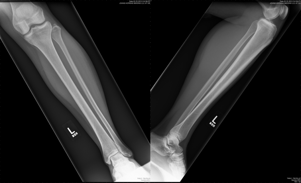 Ap And Lateral Tibia Fibula Radiographs Nucsradiology | The Best Porn ...