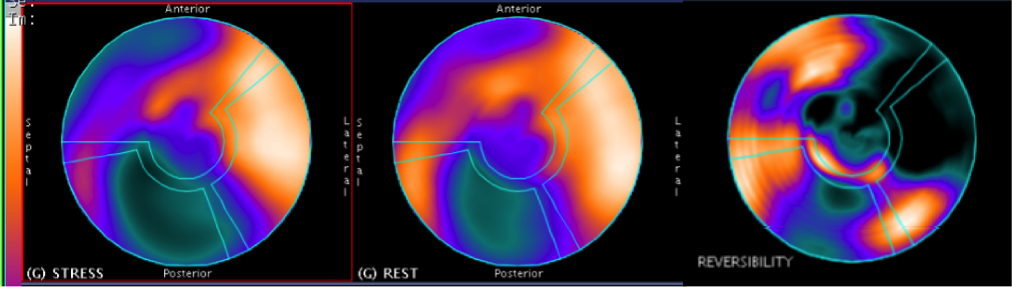 Cardiology Case 3 | NucsRadiology.com