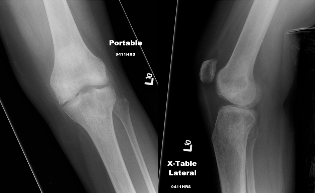 Left knee AP and lateral radiographs | NucsRadiology.com