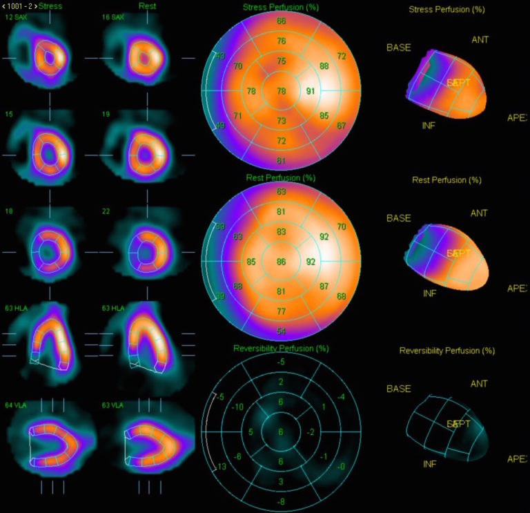 Cardiology Case 4 | NucsRadiology.com